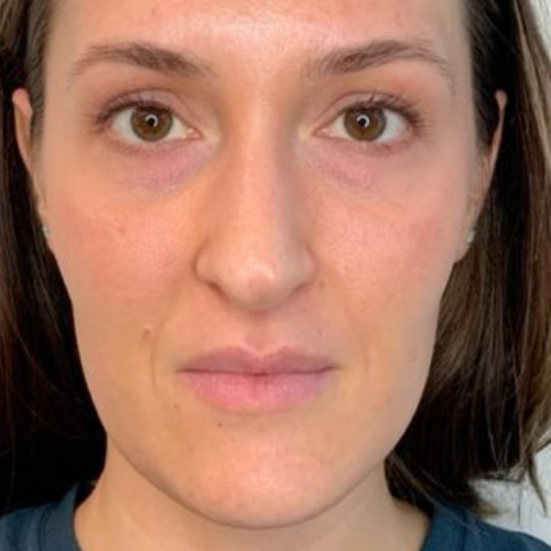 I cancelled my filler consultation.