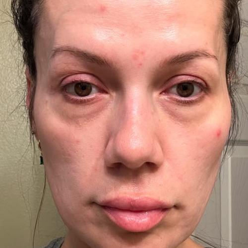 Less puffiness. More awake.